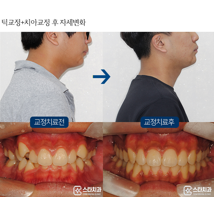 일산교정치과, 턱관절 통증, 부정교합이 문제라면 2